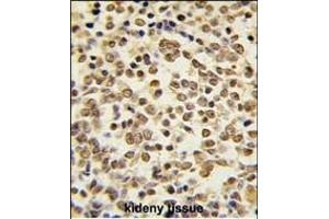 Formalin-fixed and paraffin-embedded human kideny carcinoma tissue reacted with ERK5 Antibody (C-term) (ABIN391722 and ABIN2841612) , which was peroxidase-conjugated to the secondary antibody, followed by DAB staining. (MAPK7 antibody  (C-Term))