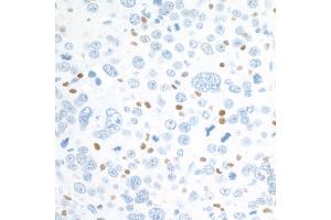 Immunohistochemistry (IHC) image for anti-V-Maf Musculoaponeurotic Fibrosarcoma Oncogene Homolog (Avian) (MAF) (AA 125-175) antibody (ABIN7455089) (Recombinant MAF antibody  (AA 125-175))