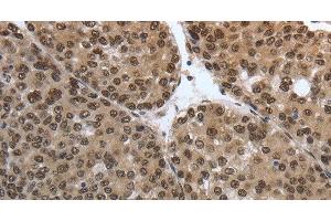 Immunohistochemistry of paraffin-embedded Human liver cancer tissue using SMAD7 Polyclonal Antibody at dilution 1:40 (SMAD7 antibody)