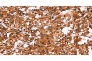 Immunohistochemistry of paraffin-embedded Human thyroid cancer using GABAA Receptor alpha1 Polyclonal Antibody at dilution of 1:30 (GABRA1 antibody)