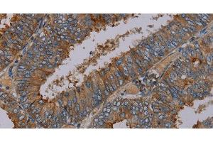 Immunohistochemistry of paraffin-embedded Human colon cancer tissue using PYY Polyclonal Antibody at dilution 1:30 (Peptide YY antibody)