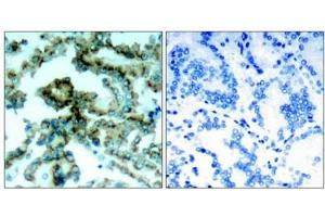 Immunohistochemical analysis of paraffin-embedded human lung carcinoma tissue, using PKCb(phospho-Thr641) antibody. (PKC beta antibody  (pThr641))