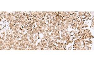Immunohistochemistry of paraffin-embedded Human ovarian cancer tissue using ELAC1 Polyclonal Antibody at dilution of 1:50(x200) (ELAC1 antibody)