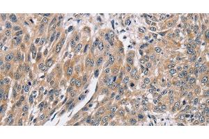 Immunohistochemistry of paraffin-embedded Human lung cancer using PPP1CC Polyclonal Antibody at dilution of 1:40 (PPP1CC antibody)