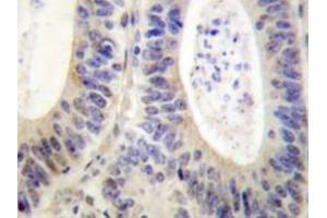 Immunohistochemistry analyzes of p47-phox antibody in paraffin-embedded human colon carcinoma tissue. (NCF1 antibody)