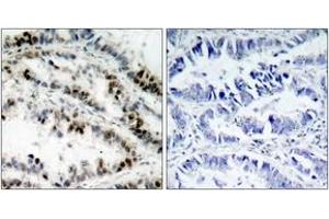 Immunohistochemistry analysis of paraffin-embedded human lung carcinoma, using SMC1 (Phospho-Ser957) Antibody. (SMC1A antibody  (pSer957))