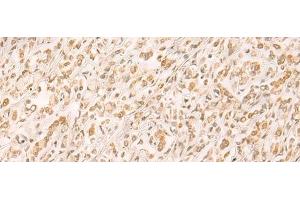 Immunohistochemistry of paraffin-embedded Human gastric cancer tissue using SETD1A Polyclonal Antibody at dilution of 1:25(x200)