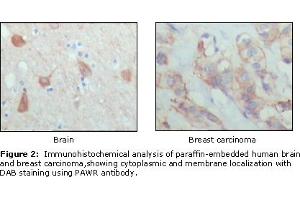 Immunohistochemical analysis of paraffin-embedded human brain (left) and breast carcinoma (right), showing cytoplasmic and membrane localization using PAR4 mouse mAb with DAB staining. (F2RL3 antibody  (AA 1-330))