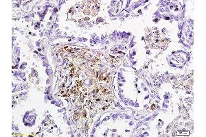 Formalin-fixed and paraffin embedded human lung carcinoma labeled with Anti-DKK3 Polyclonal Antibody, Unconjugated (ABIN749123) followed by conjugation to the secondary antibody and DAB staining (DKK3 antibody  (AA 31-130))