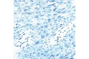 Immunohistochemical staining for human papilloma virus (HPV) type 16, L1 protein. (L1 Protein antibody)