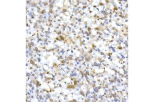 Immunohistochemistry of paraffin-embedded Undifferentiated carcinoma of human esophagus using SM/SNF5 Rabbit pAb  at dilution of 1:250 (40x lens). (SMARCB1 antibody  (AA 77-376))