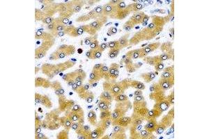 Immunohistochemical analysis of MDH2 staining in human liver cancer formalin fixed paraffin embedded tissue section. (MDH2 antibody)