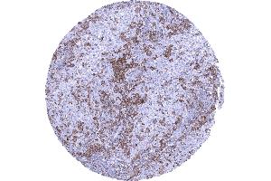 Uterus cervix TIM3 negative squamous cell carcinoma showing a large number of TIM3 positive macrophages and also lymphocytes (Recombinant TIM3 antibody)