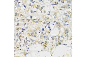 Immunohistochemistry of paraffin-embedded human breast cancer using MLKL antibody (ABIN6134395, ABIN6143882, ABIN6143886 and ABIN6217454) at dilution of 1:100 (40x lens).