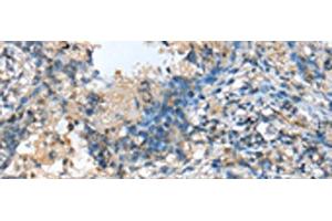 Immunohistochemistry of paraffin-embedded Human lung cancer tissue using MOB4 Polyclonal Antibody at dilution of 1:25(x200) (MOBKL3 antibody)