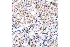 Immunohistochemistry of paraffin-embedded human breast carcinoma tissue, using Phospho-CDKN1B-T187 antibody (ABIN2987947). (CDKN1B antibody  (pThr187))