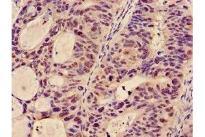 Immunohistochemistry of paraffin-embedded human colon cancer using ABIN7145363 at dilution of 1:100 (GCNT3 antibody  (AA 250-419))
