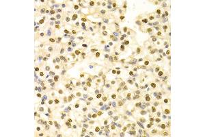 Immunohistochemistry of paraffin-embedded human kidney cancer using HDGF Antibody (ABIN1876535) at dilution of 1:100 (40x lens). (HDGF antibody)
