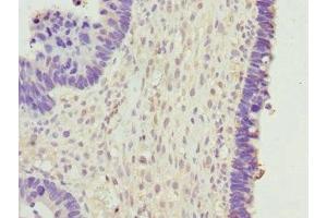 Immunohistochemistry of paraffin-embedded human ovarian cancer using ABIN7145624 at dilution of 1:100 (BPGM antibody  (AA 1-259))