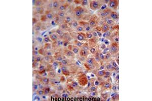 CFH antibody (Center) immunohistochemistry analysis in formalin fixed and paraffin embedded human hepatocarcinoma followed by peroxidase conjugation of the secondary antibody and DAB staining. (Complement Factor H antibody  (Middle Region))