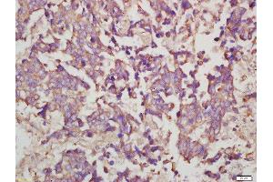 Formalin-fixed and paraffin embedded human lung carcinoma labeled with Rabbit Anti-Myosin VIIa Polyclonal Antibody, Unconjugated  at 1:200 followed by conjugation to the secondary antibody and DAB staining (Myosin VIIA antibody  (AA 851-950))