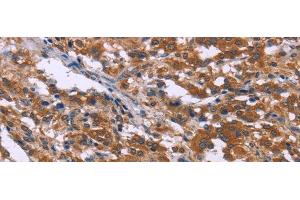Immunohistochemistry of paraffin-embedded Human thyroid cancer tissue using SKI Polyclonal Antibody at dilution 1:40 (SKI antibody)