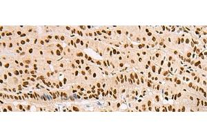 Immunohistochemistry of paraffin-embedded Human thyroid cancer tissue using XRCC4 Polyclonal Antibody at dilution of 1:60(x200)