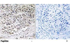 Immunohistochemistry analysis of paraffin-embedded human breast carcinoma tissue using AZI1 polyclonal antibody . (AZI1 antibody)