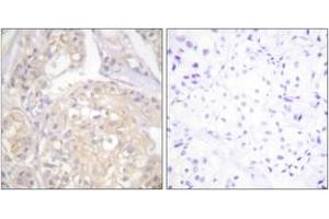 Immunohistochemistry analysis of paraffin-embedded human breast carcinoma, using FGFR1 (Phospho-Tyr766) Antibody. (FGFR1 antibody  (pTyr766))