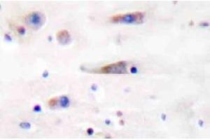 Immunohistochemistry (IHC) analyzes of NMDAzeta1 antibody in paraffin-embedded human breast carcinoma tissue. (NMDA 1 Receptor antibody)