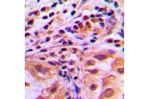 Immunohistochemical analysis of FOXO1 (pS256) staining in human lung cancer formalin fixed paraffin embedded tissue section. (FOXO1 antibody  (pSer256))