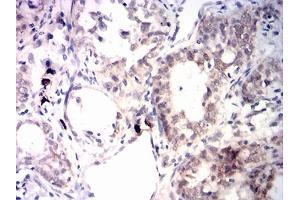 Immunohistochemistry (IHC) image for anti-Insulin-Like Growth Factor 2 mRNA Binding Protein 3 (IGF2BP3) (AA 430-579) antibody (ABIN7193581)
