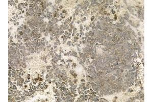 ABIN6261003 and ABIN6273036 at 1/100 staining human melanoma by IHC-P.