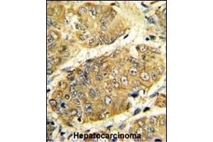 Formalin-fixed and paraffin-embedded human hepatocarcinoma reacted with LTA Antibody (Center), which was peroxidase-conjugated to the secondary antibody, followed by DAB staining. (LTA antibody  (AA 46-72))