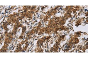 Immunohistochemistry of paraffin-embedded Human gastic cancer using IL17RB Polyclonal Antibody at dilution of 1:40 (IL17 Receptor B antibody)