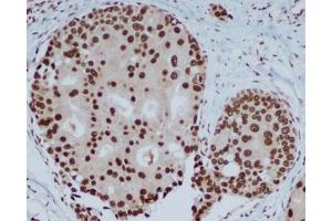 Immunohistochemical analysis of paraffin-embedded human breast carcinoma with HP1 alpha mouse mAb (3G2-H10-A6, 1:400 diluted ),showing nuclear localization. (CBX5 antibody)