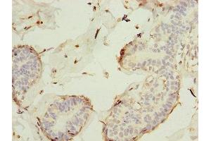 Immunohistochemistry of paraffin-embedded human breast cancer using ABIN7157312 at dilution of 1:100 (KEL antibody  (AA 201-500))