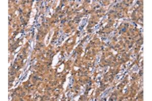 The image on the left is immunohistochemistry of paraffin-embedded Human gastic cancer tissue using ABIN7190999(HRASLS2 Antibody) at dilution 1/20, on the right is treated with synthetic peptide. (HRASLS2 antibody)