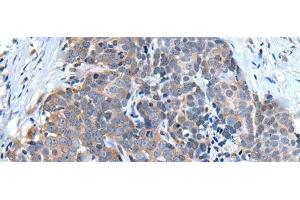 Immunohistochemistry of paraffin-embedded Human thyroid cancer tissue using UBQLN2 Polyclonal Antibody at dilution of 1:45(x200) (Ubiquilin 2 antibody)