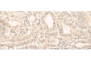 Immunohistochemistry of paraffin-embedded Human thyroid cancer tissue using UBXN1 Polyclonal Antibody at dilution of 1:35(x200) (UBXN1 antibody)