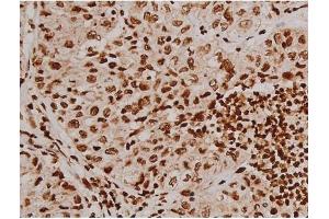 ABIN6267607 at 1/200 staining Human lung cancer tissue sections by IHC-P. (FAK antibody  (pTyr397))