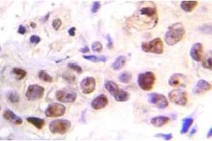 Immunohistochemistry (IHC) analyzes of p-ATM antibody in paraffin-embedded human breast carcinoma tissue. (ATM antibody  (pSer1981))