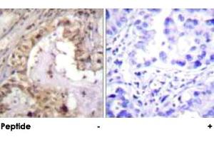 Immunohistochemical analysis of paraffin-embedded human lung carcinoma tissue using BCL2L1 polyclonal antibody . (BCL2L1 antibody)