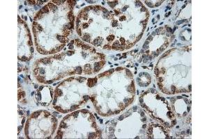 Immunohistochemical staining of paraffin-embedded Adenocarcinoma of ovary tissue using anti-LIPG mouse monoclonal antibody. (LIPG antibody)