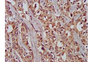 IHC image of ABIN7166315 diluted at 1:200 and staining in paraffin-embedded human liver cancer performed on a Leica BondTM system. (WNT8A antibody  (AA 223-309))