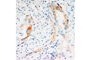 Immunohistochemical staining of CASP2 on formalin fixed, paraffin embedded human mammary cancer with CASP2 polyclonal antibody . (Caspase 2 antibody  (C-Term))