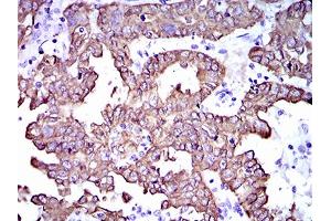 Immunohistochemical analysis of paraffin-embedded endometrial cancer tissues using CK5 mouse mAb with DAB staining. (Cytokeratin 5 antibody  (AA 316-590))