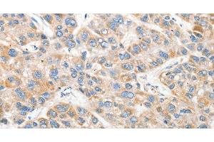 Immunohistochemistry of paraffin-embedded Human liver cancer tissue using ANAPC2 Polyclonal Antibody at dilution 1:30 (ANAPC2 antibody)