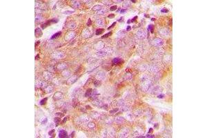 Immunohistochemical analysis of CEP76 staining in human breast cancer formalin fixed paraffin embedded tissue section. (Cep76 antibody)