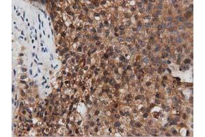 Immunohistochemical staining of paraffin-embedded Carcinoma of Human pancreas tissue using anti-PEPD mouse monoclonal antibody. (PEPD antibody)
